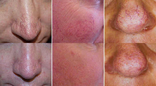 Before and after Thread Vein Therapy